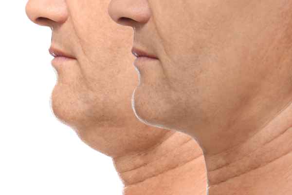 HIFU - Breakthrough in Anti - ageing 2 hifu results Beaconsfield