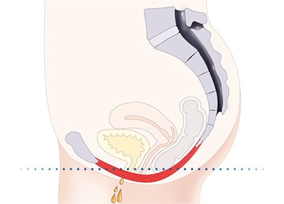 Pelvic-Floor Muscle Repair 5 Pelvic floor muscles Beaconsfield