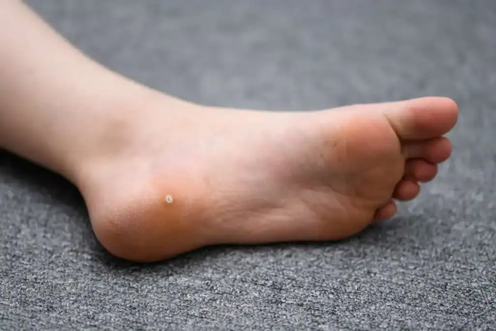 Cryotherapy For Warts And Also Verrucas 2 Image of verruca on the bottom of the foot that able to be treated with Cryotherapy Beaconsfield