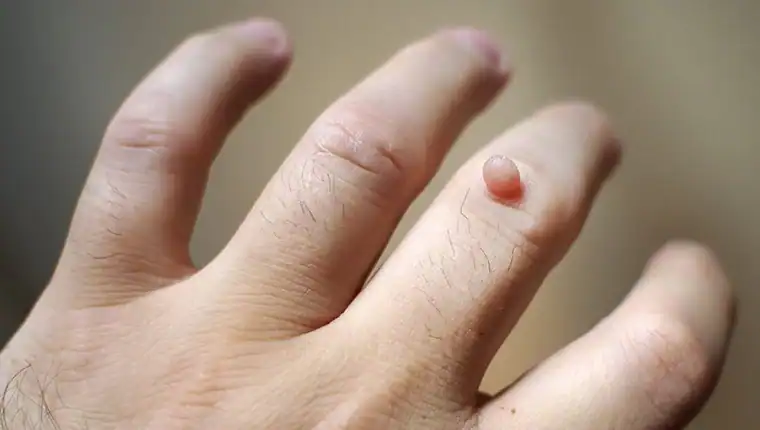 Image of blemish that Cryotherapy Beaconsfield can remove with Lipo 360.