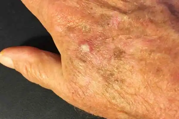 Image of Actinic keratoses Beaconsfield on a person hand
