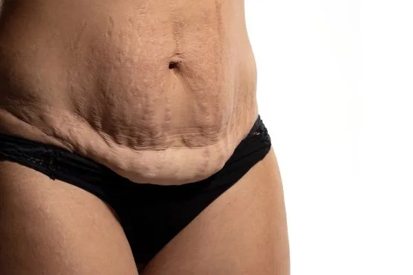 The Science of Skin Tightening 1 The science behind skin tightening Beaconsfield picture of a woman's sagging skin on the stomach